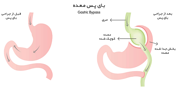 جراحی بای پس معده