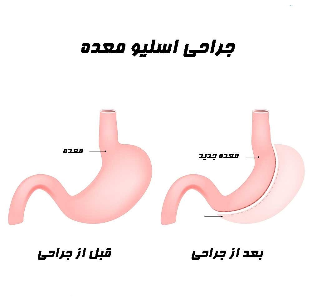 حذف شدن بخش زیادی از معده