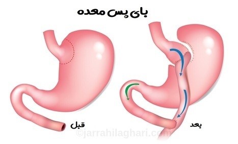 پزشک معده را به دو قسمت بزرگ و کوچک تقسیم می کند