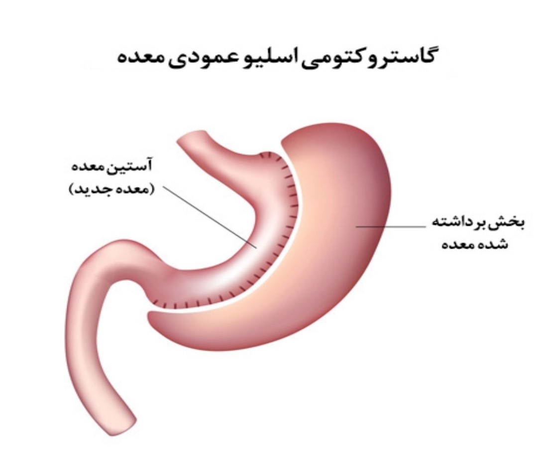 اسلیو معده