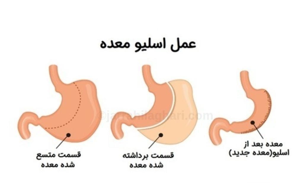 انتخاب پزشک متخصص، امری بسیار حیاتی در پیشگیری از نشتی معده بعد از عمل اسلیو معده