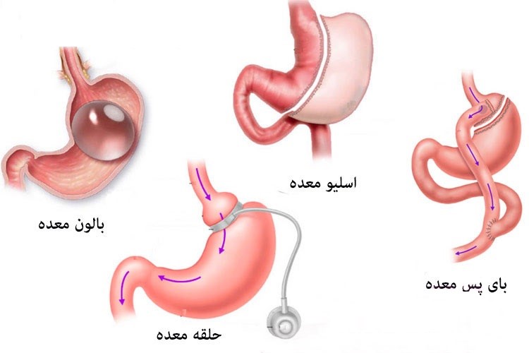 انواع جراحی چاقی