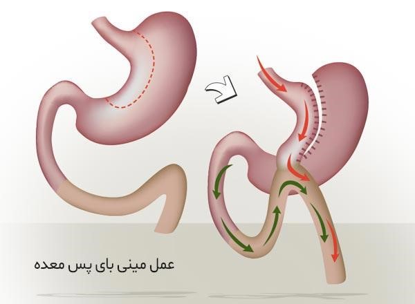 آمادگی قبل از عمل بای پس معده