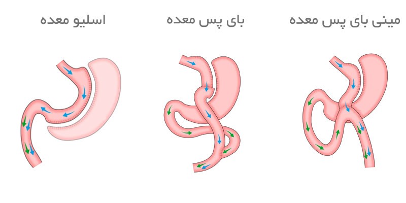 فرق اسلیو معده با بای پس