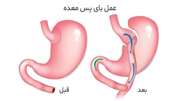 بای پس معده