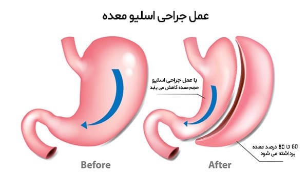 مزایای جراحی اسلیو معده