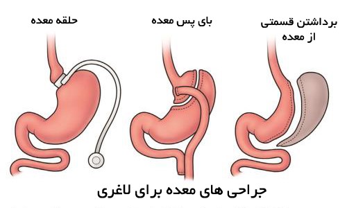 انواع جراحی چاقی در ساری کدامند؟