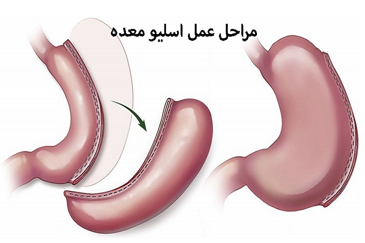 مراحل جراحی اسلیو معده