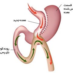 دکتر بای پس معده مشهد