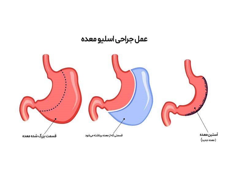 درباره عمل اسلیو بیشتر بدانید!